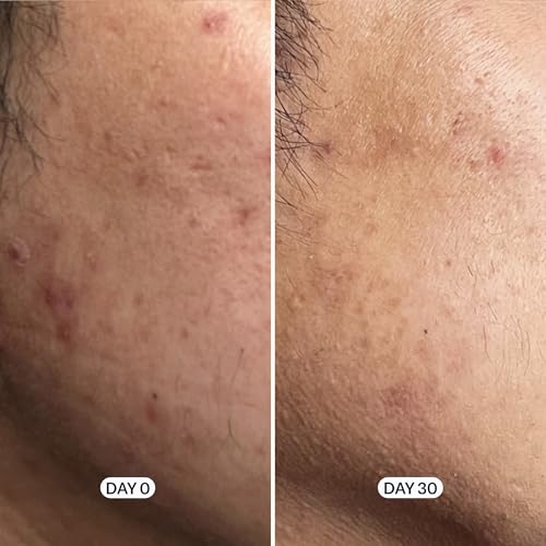 Geologie Skin Repair Moisturizer Face Cream | Clear System Retinol Resurfacing Formula | For Blemish Prone Skin with Niacinamide & Hyaluronic Acid | 60 ML
