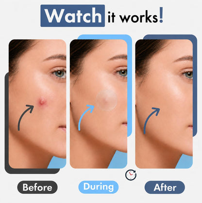 Hellados™ 450 Pimple Patches For Face, 4 Size Hydrocolloid Acne Patches