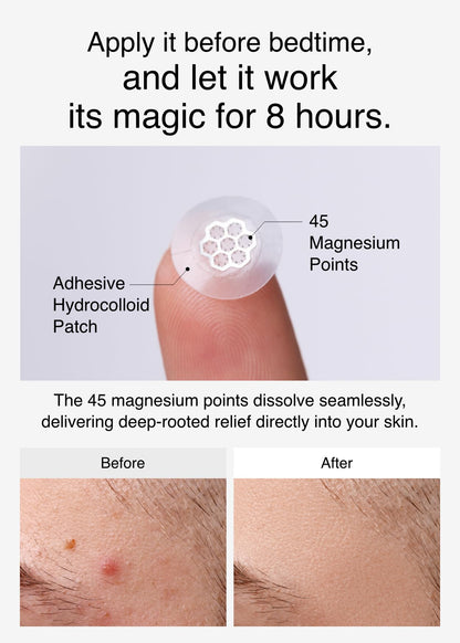 EasyDerm Quick Microdart Magnesium Pimple Patch 10ea - Cica Ampoule&Tweezer