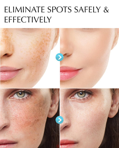 EnaSkin Dark Spot Remover for Face & Body with Niacinamide, Corrector Cream