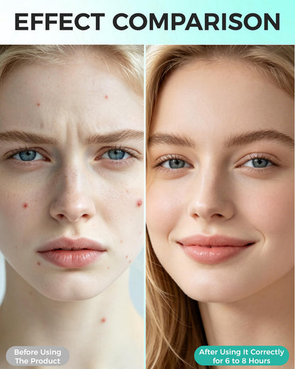 Pimple Patches for Face, 36ct Acne Patches, Microdart & Microneedle Patches