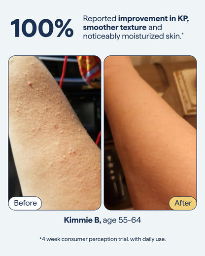 REMEDY KP Body Moisturizer, Exfoliating and Moisturizing Lotion