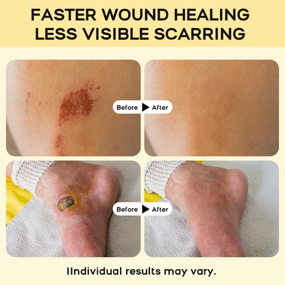 Medical Grade Manuka Honey Wound Care(MGO 949), Medihoney Wound Gel - Speed up Healing for Cuts, Surgical Wounds, Scars, Foot Ulcers, Burns, 4 oz
