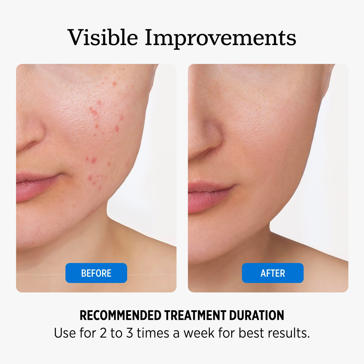NUVADERMIS 35% Glycolic Acid Peel Pads – Exfoliating Facial Resurfacing for Blackheads, Dark Spots, and Acne – Safe for Sensitive Skin – 60 Double-Sided Pads