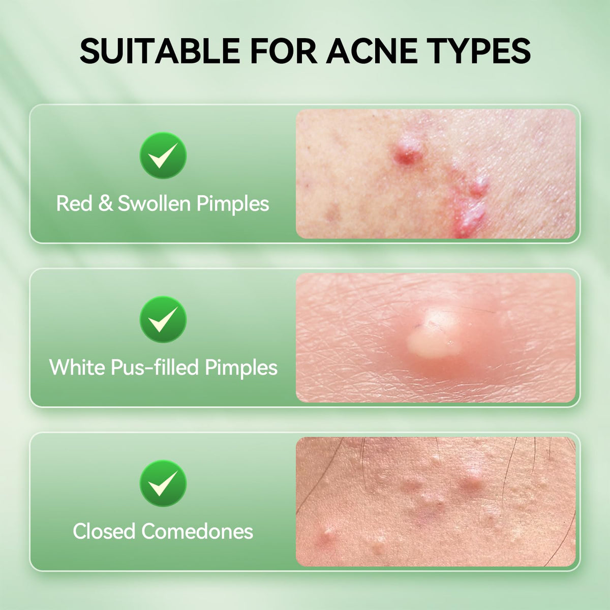 LANBENA 2% Salicylic Acid Acne Spot Treatment Drying Lotion, 0.42 Fl Oz
