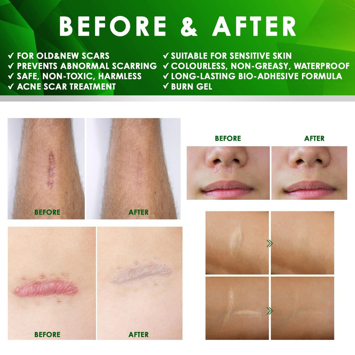 Tobcharm Advanced Keloid Bump Removal: Silicone Keloid Scar Removal Cream for Scars from Piercing, Surgical Marks, Acne, and Burns, Keloid Treatment for Ears, Face, and Body with Healing Formula 30g
