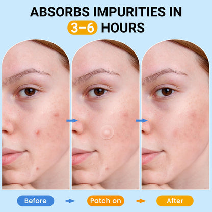 Dr.fines 800 Counts Pimple Patches - Hydrocolloid Acne Patches for face