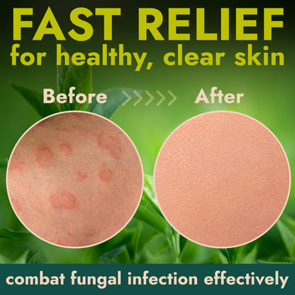Body Wipes with 1% Tolnaftate for Ringworm, Jock Itch & Athlete's Foot