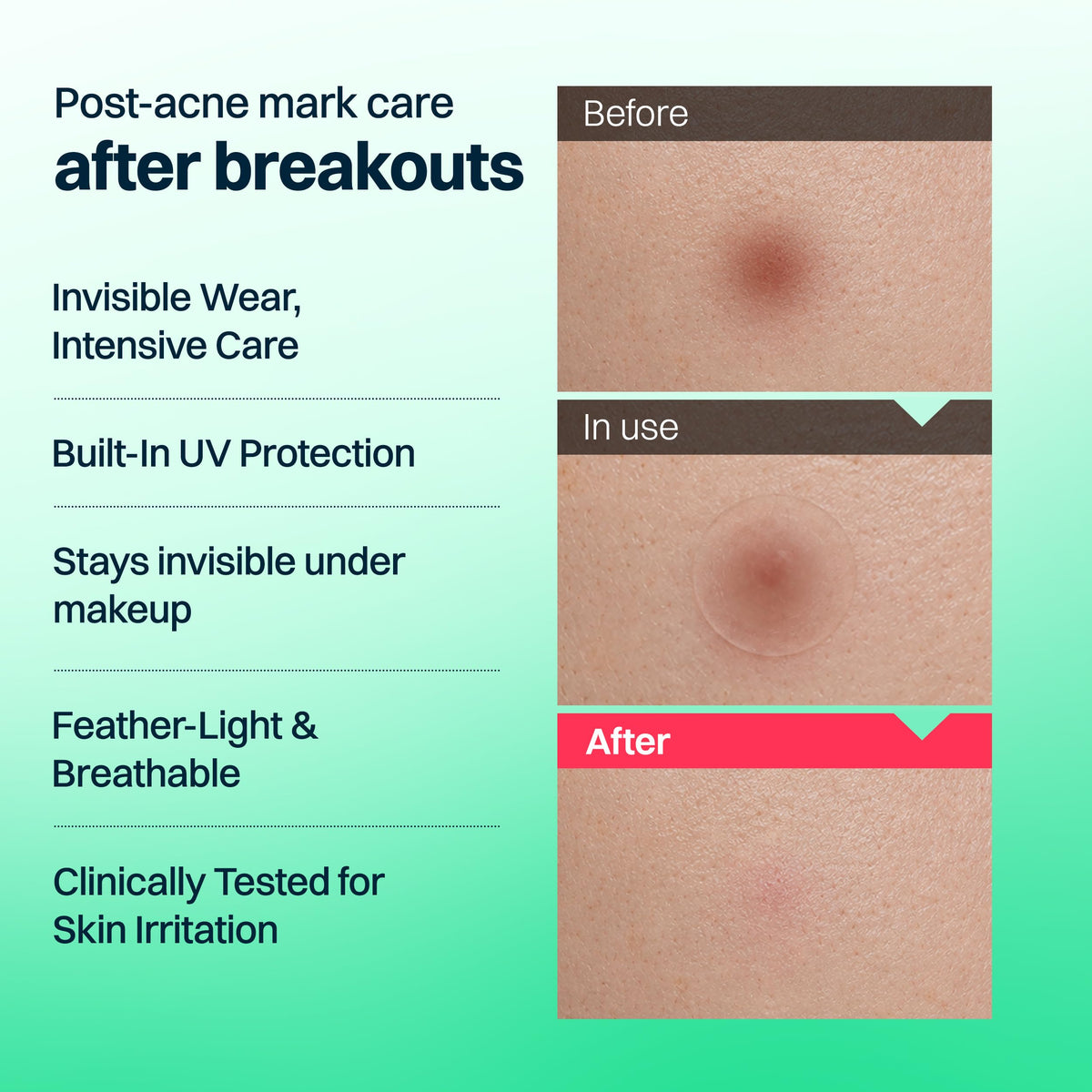 FRANZ Invisible Post-Acne Mark Patches for Dark Spots, 72 Count