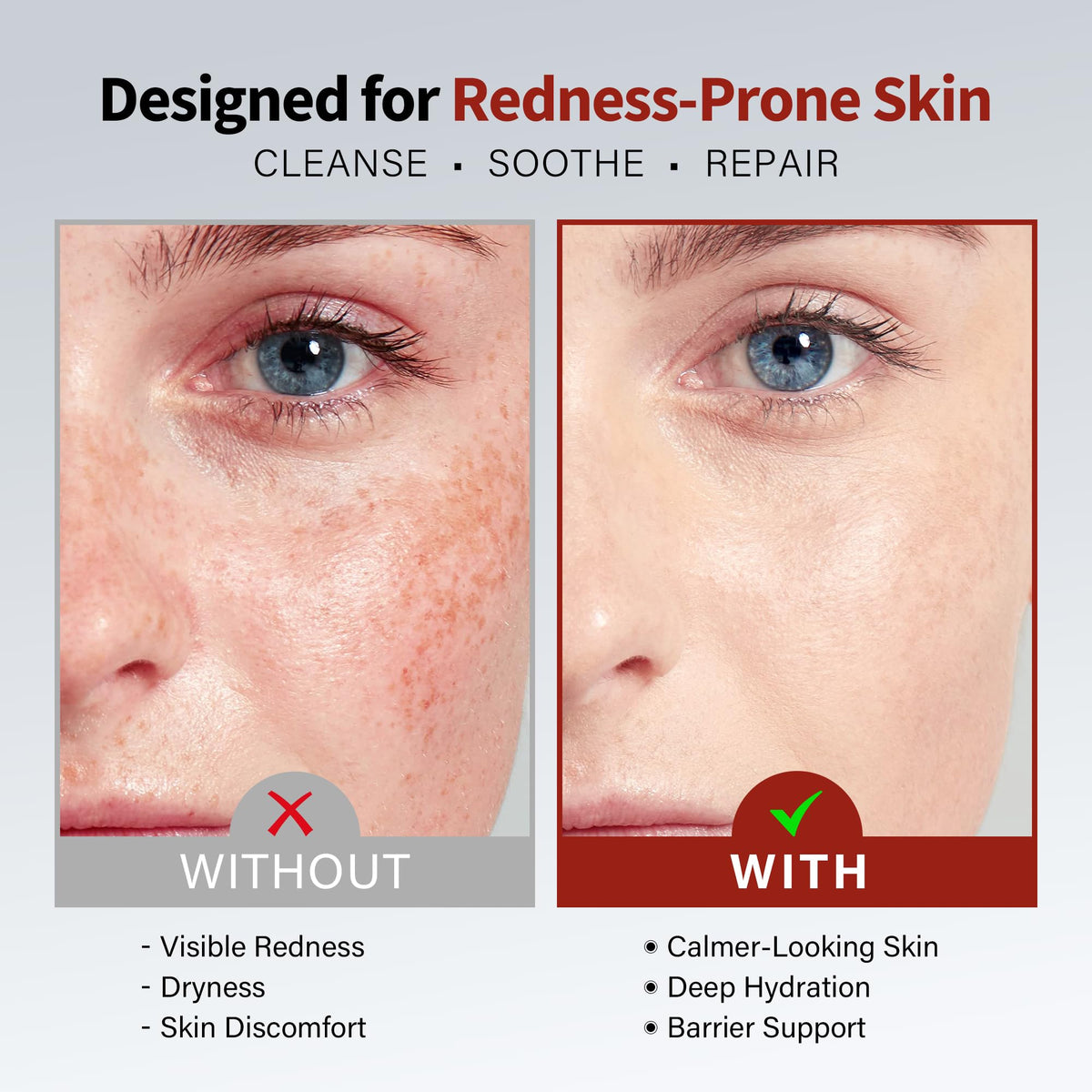 Rosacea Treatment for Face Anti-Redness Serum 50mL / 1.69 fl.oz