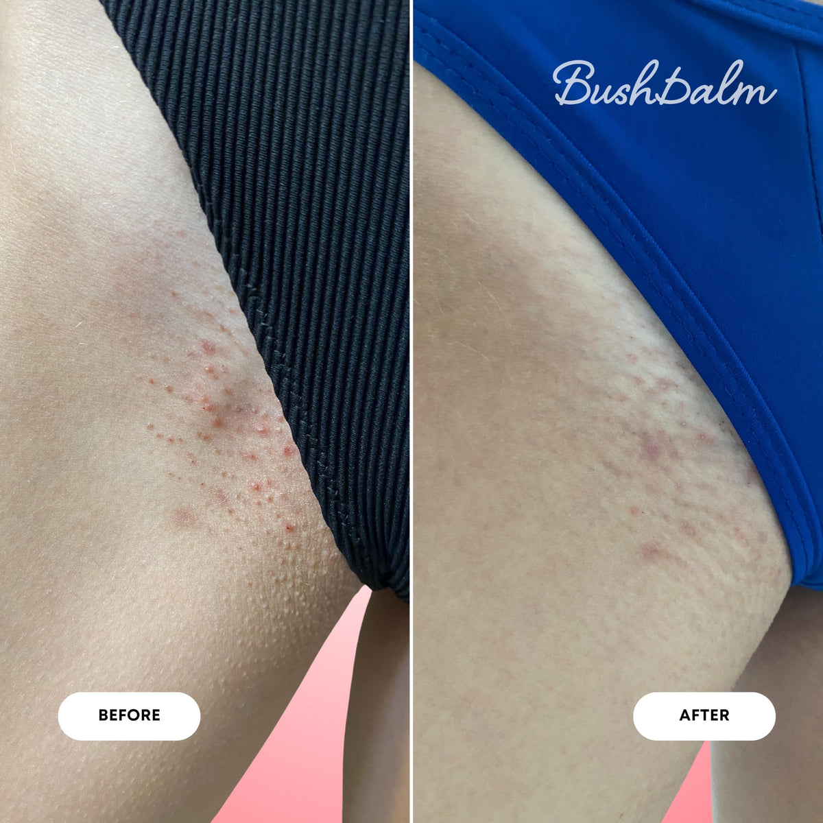 Bushbalm 2-Step Ingrown Hair Routine - Watermelon Sugar Oil & Body Scrub