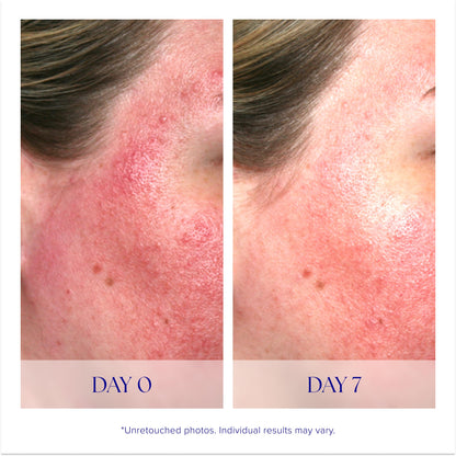 iS CLINICAL Pro-Heal Serum Advance+ Antioxidant-Rich Serum With Vitamin C, E, and A for Redness, Inflammation, Wrinkle-Smoothing, Sun Damage Repairing - 1 Fl Oz