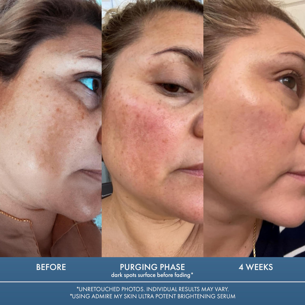 Admire My Skin Dark Spot Corrector Remover for Face Brightening Serum 1oz
