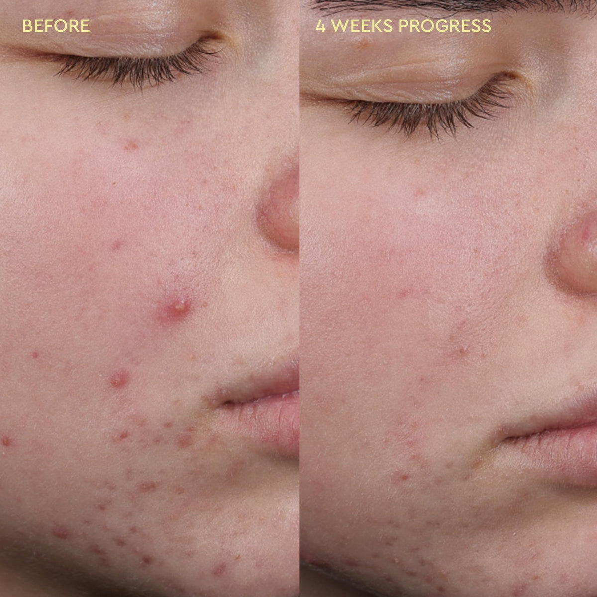 BYOMA Blemish Acne Clearing Cleanser, for Acne-Prone Skin (175ml)