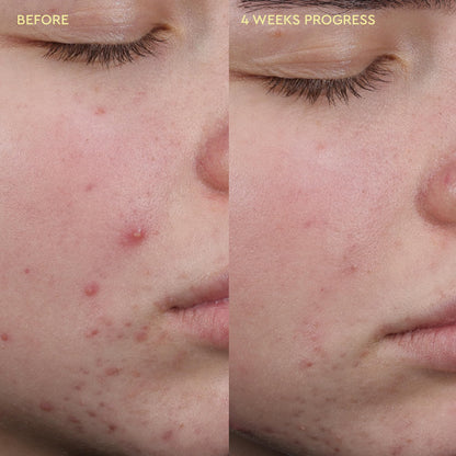 BYOMA Blemish Acne Clearing Cleanser, for Acne-Prone Skin (175ml)