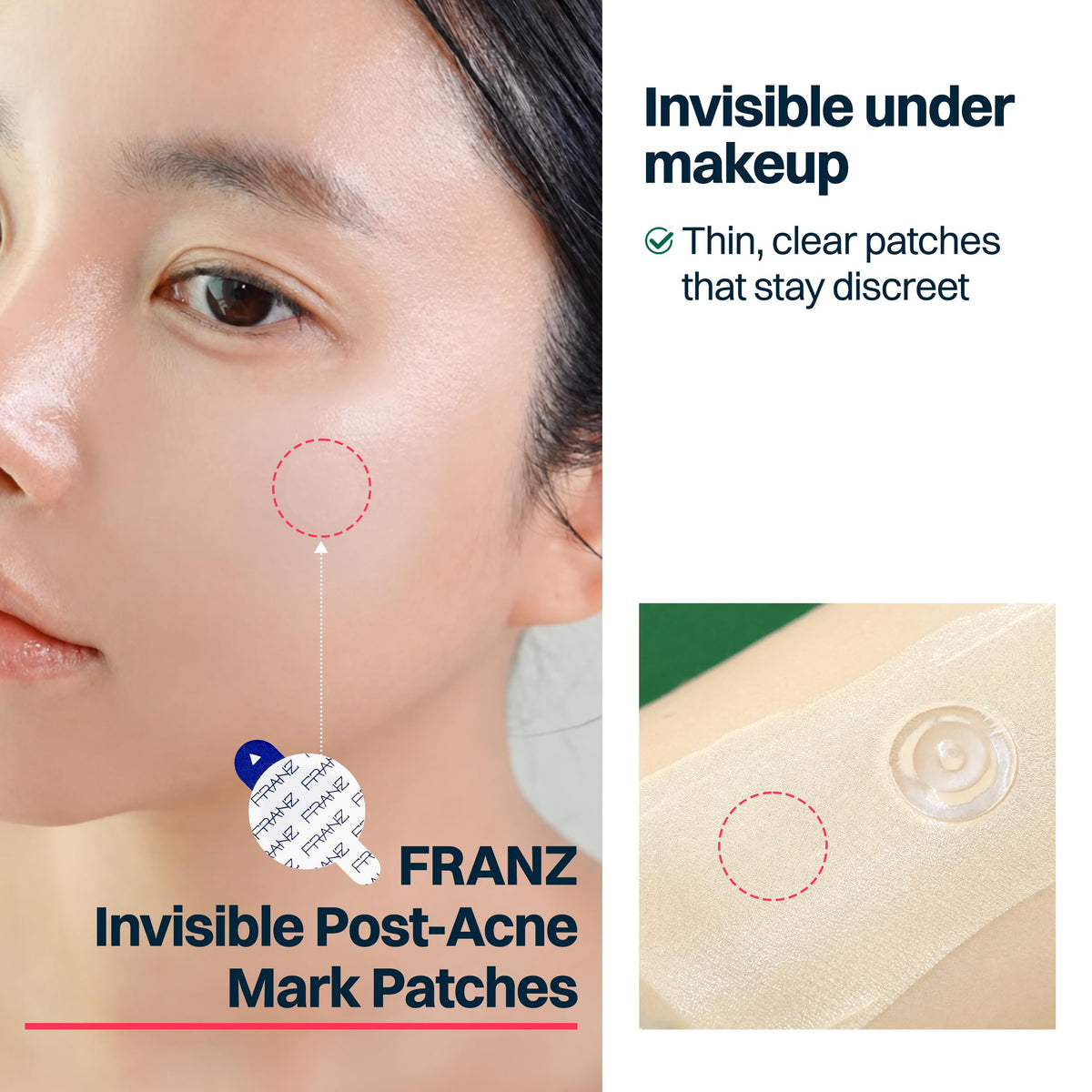 FRANZ Invisible Post-Acne Mark Patches for Dark Spots, 72 Count