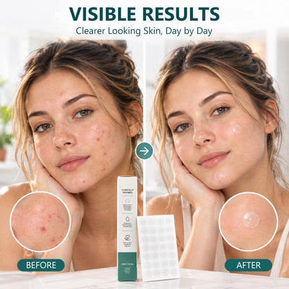 Microdart Acne Patches 288ct - 2-in-1 Dissolving Microneedle Clear Patches with