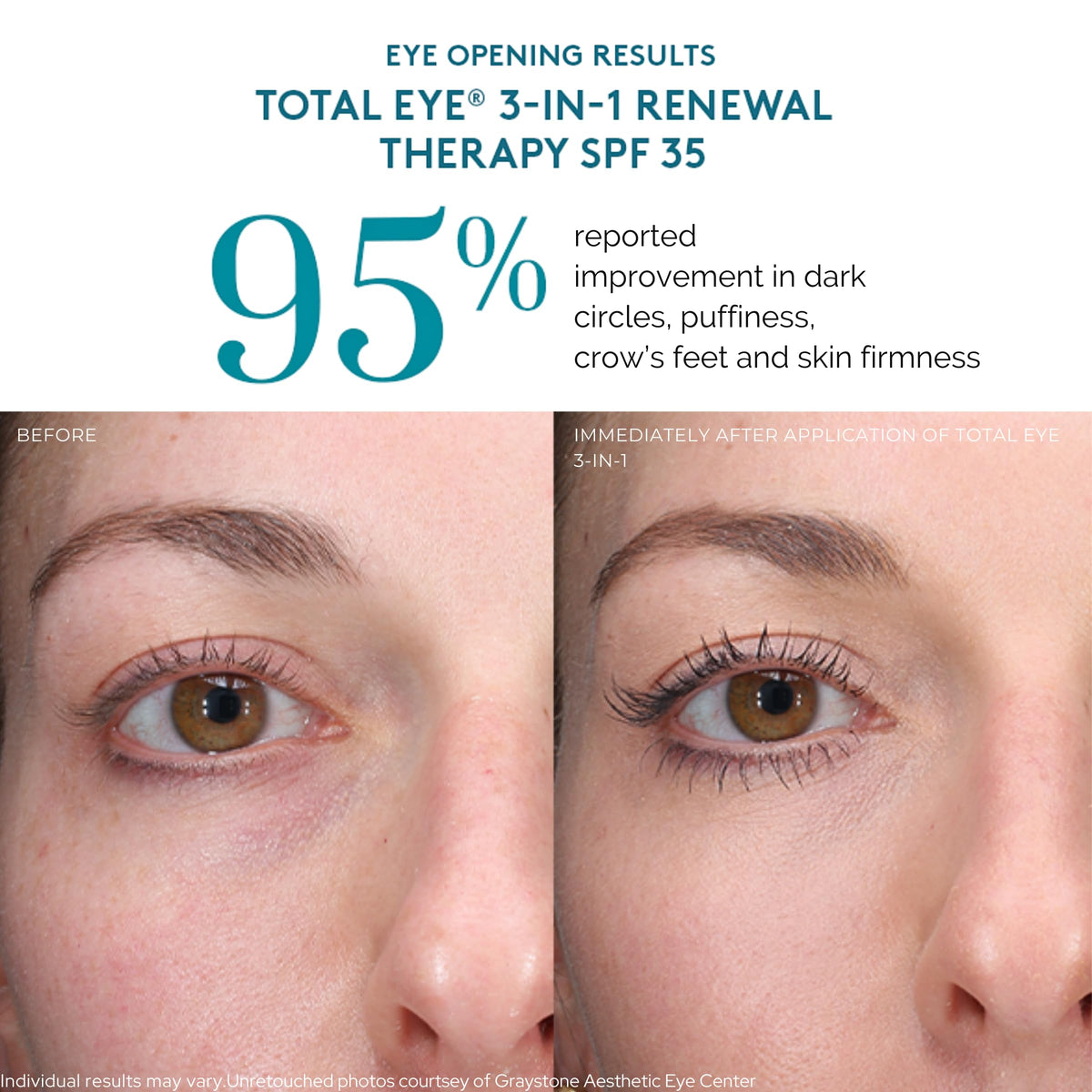 Colorescience, Total Eye 3-in-1 Renewal Therapy, SPF 35, Medium