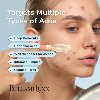BellamiLuxx Cystic Acne Treatment for Face: Hormonal Acne Treatment Cream for Teens & Adults - Salicylic Acid & Tea Tree Oil Pimple Spot Remover - Anti-Acne Moisturizer Reduces Redness, Blemishes