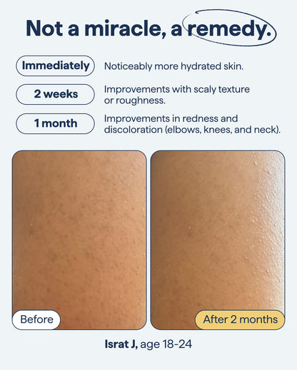 REMEDY KP Body Moisturizer, Exfoliating and Moisturizing Lotion